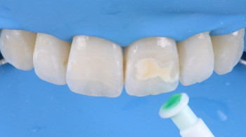Zahnärztin Icon-Behandlung